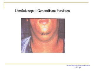 Yayasan Pelayanan Anak dan Keluarga
( L A Y A K )
Limfadenopati Generalisata Persisten
 