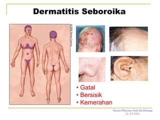 Yayasan Pelayanan Anak dan Keluarga
( L A Y A K )
Dermatitis Seboroika
• Gatal
• Bersisik
• Kemerahan
 