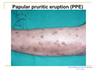Yayasan Pelayanan Anak dan Keluarga
( L A Y A K )
Papular pruritic eruption (PPE)
 