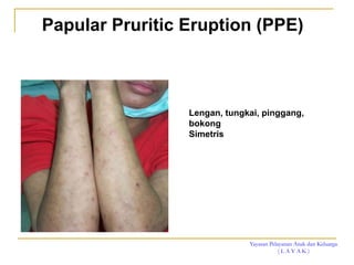 Yayasan Pelayanan Anak dan Keluarga
( L A Y A K )
Lengan, tungkai, pinggang,
bokong
Simetris
Papular Pruritic Eruption (PPE)
 