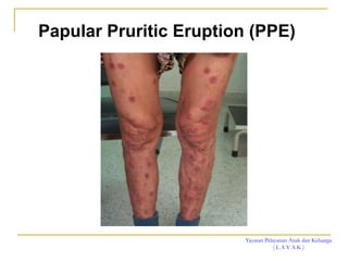 Yayasan Pelayanan Anak dan Keluarga
( L A Y A K )
Papular Pruritic Eruption (PPE)
 