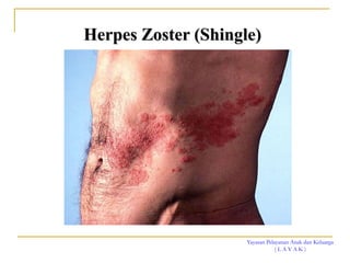 Yayasan Pelayanan Anak dan Keluarga
( L A Y A K )
Herpes Zoster (Shingle)
 