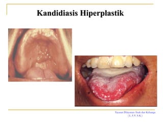Yayasan Pelayanan Anak dan Keluarga
( L A Y A K )
Kandidiasis Hiperplastik
 