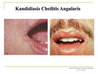Yayasan Pelayanan Anak dan Keluarga
( L A Y A K )
Kandidiasis Cheilitis Angularis
 