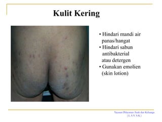 Yayasan Pelayanan Anak dan Keluarga
( L A Y A K )
Kulit Kering
• Hindari mandi air
panas/hangat
• Hindari sabun
antibakterial
atau detergen
• Gunakan emolien
(skin lotion)
 