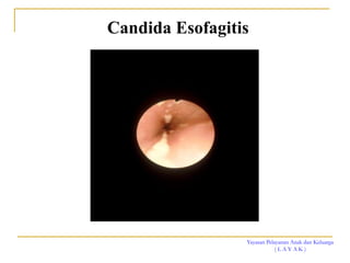 Yayasan Pelayanan Anak dan Keluarga
( L A Y A K )
Candida Esofagitis
 