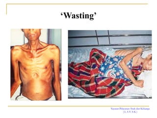 Yayasan Pelayanan Anak dan Keluarga
( L A Y A K )
‘Wasting’
 