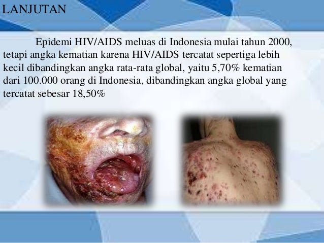 Penyakit hiv di indonesia