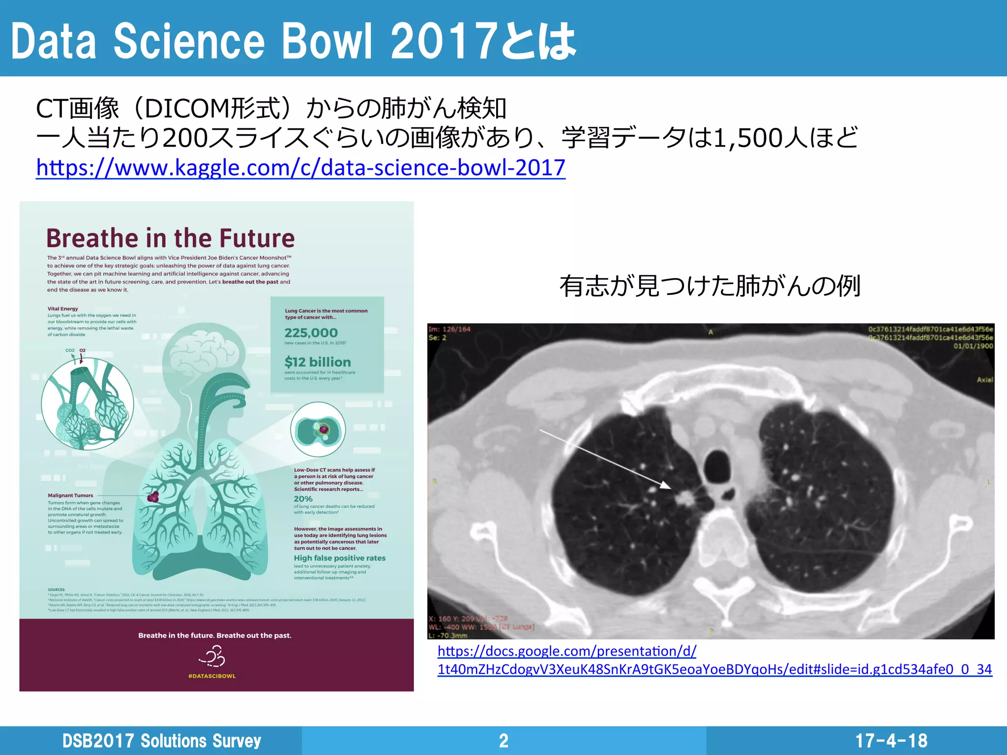 Data  Science  Bowl  2017とは
17-4-18DSB2017  Solutions  Survey 2
CT画像（DICOM形式）からの肺がん検知
⼀一⼈人当たり200スライスぐらいの画像があり、学習データは1,500⼈人ほど
h"ps://docs.google.com/presenta3on/d/
1t40mZHzCdogvV3XeuK48SnKrA9tGK5eoaYoeBDYqoHs/edit#slide=id.g1cd534afe0_0_34	
  
有志が⾒見見つけた肺がんの例例
h"ps://www.kaggle.com/c/data-­‐science-­‐bowl-­‐2017	
  
 