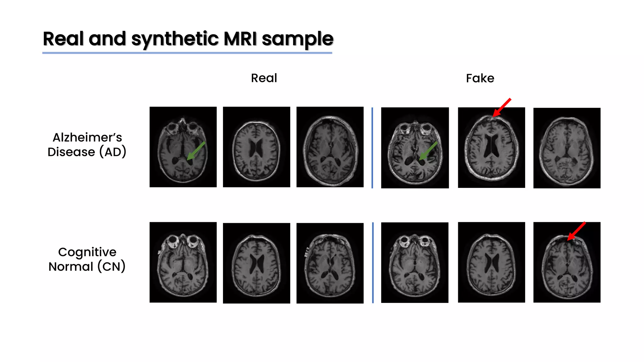 Real and synthetic MRI sample
Real Fake
Alzheimer’s
Disease (AD)
Cognitive
Normal (CN)
 