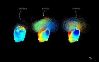 PLOS
Viz by:
VEGETATIVE STAGE BRAIN DAMAGE HEALTHY PERSON
 