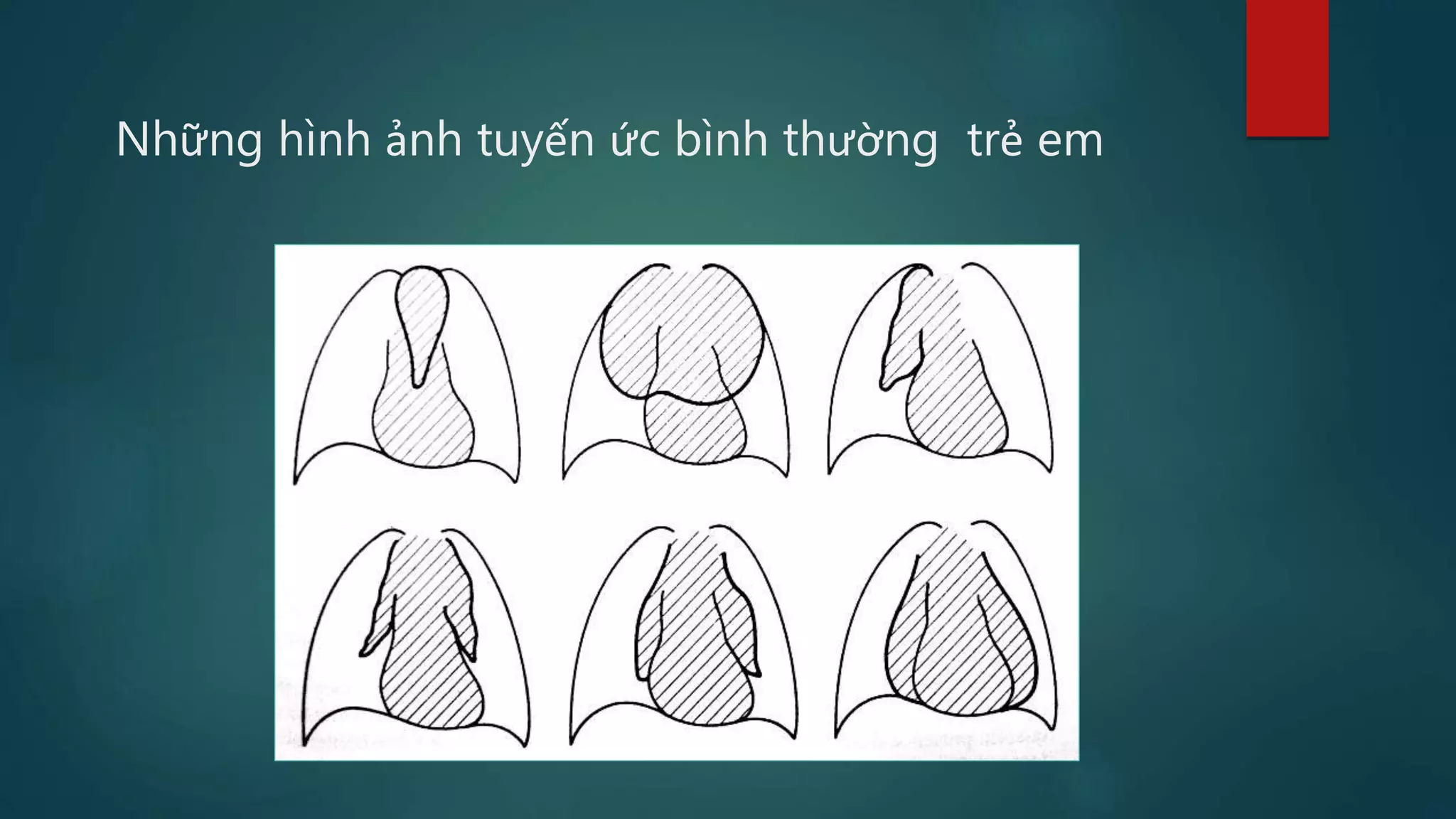 Dau hieu x quang ngực (signsinchestxray) | PDF