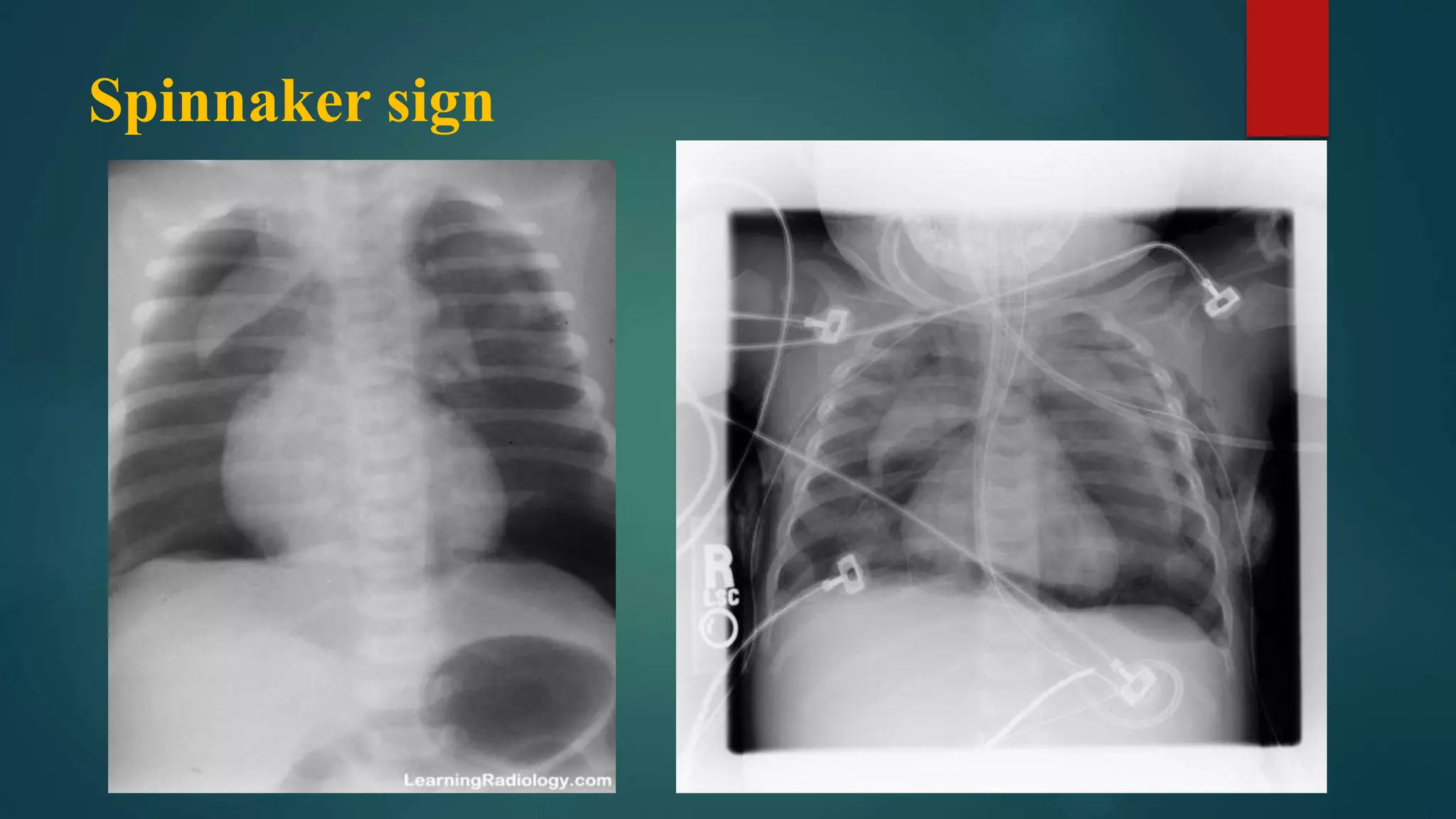 Spinacker Sign Dau hieu x quang ngực (signsinchestxray) | PDF