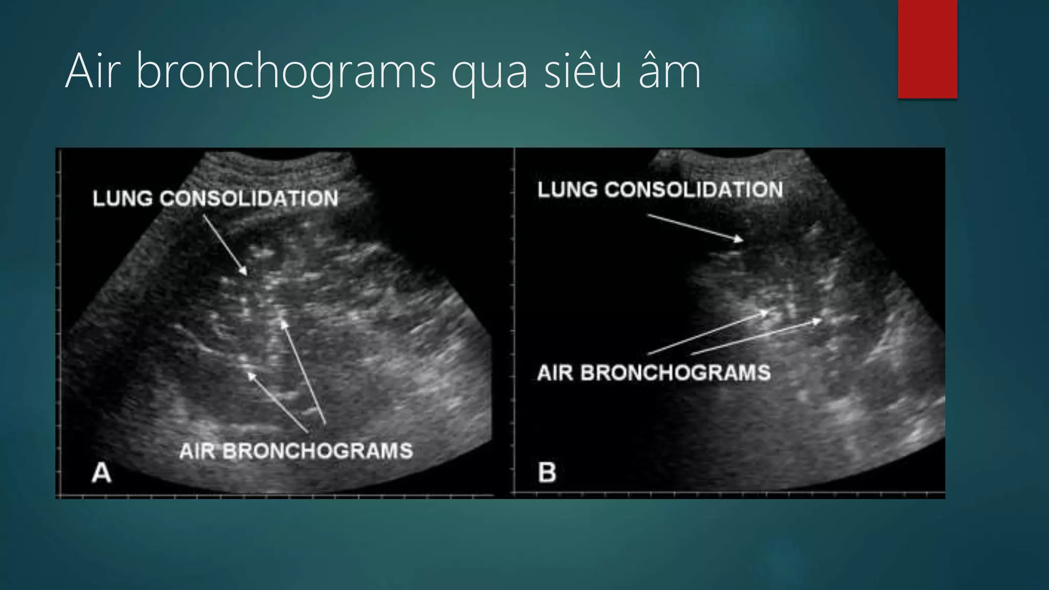 Dau hieu x quang ngực (signsinchestxray) | PDF