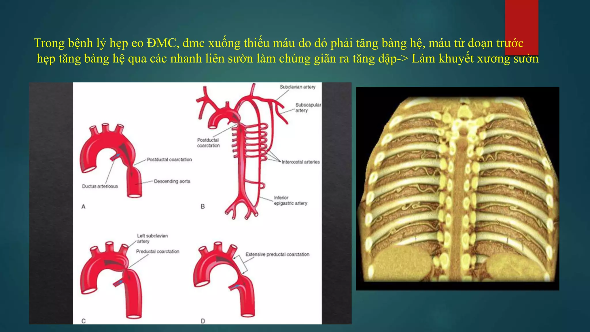 Dau hieu x quang ngực (signsinchestxray) | PDF