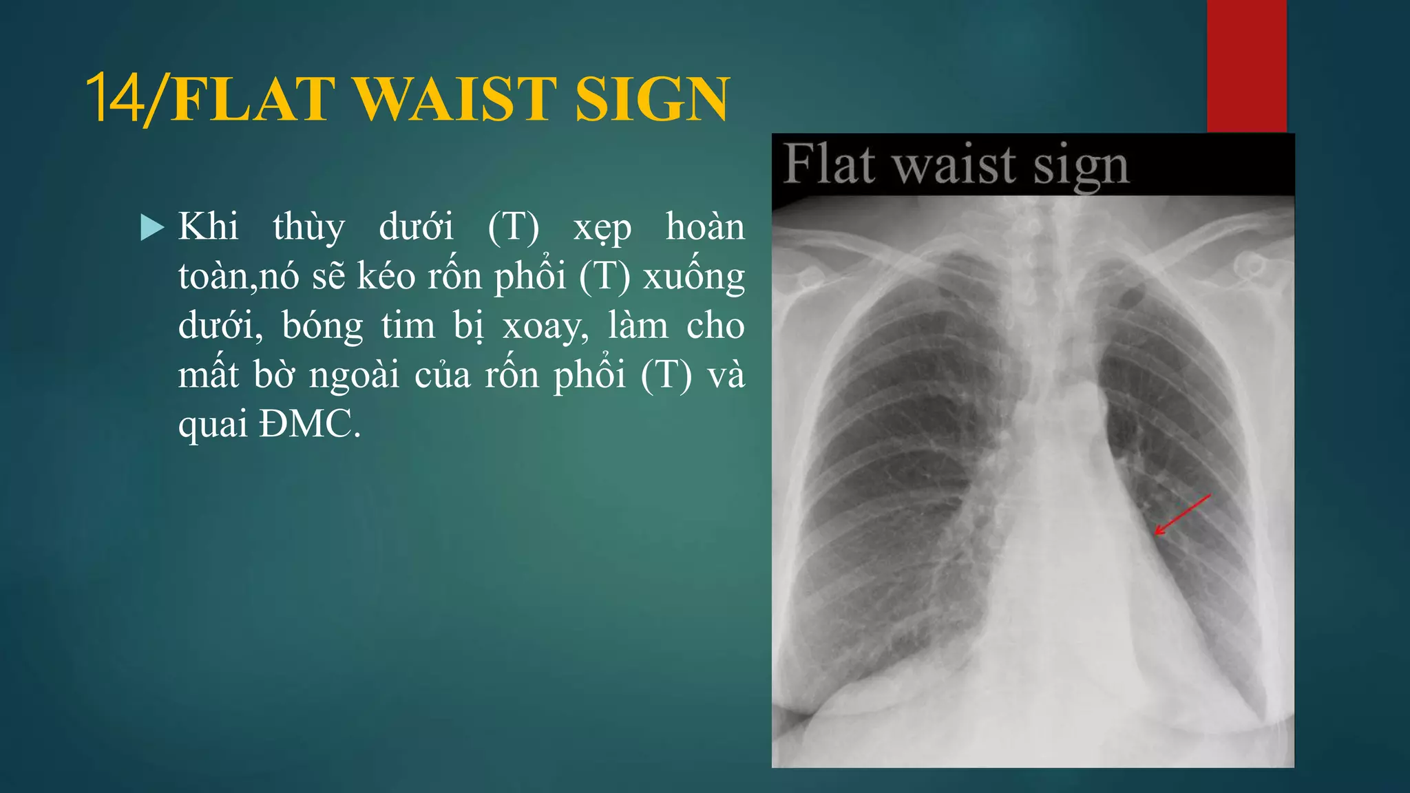 Dau hieu x quang ngực (signsinchestxray) | PDF