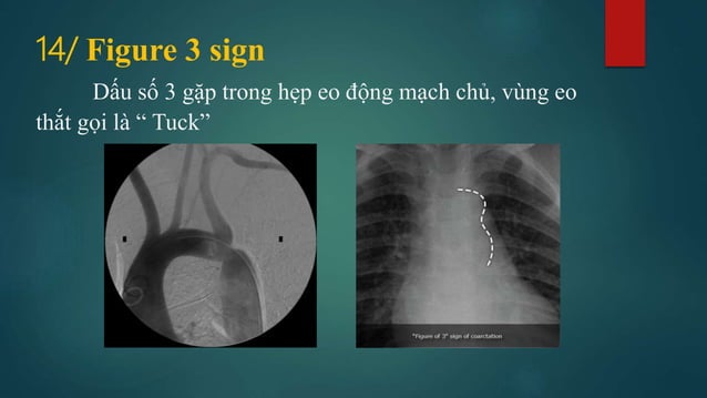 Dau hieu x quang ngực (signsinchestxray) | PDF
