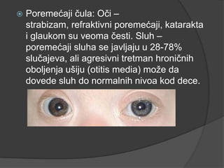 

Poremećaji čula: Oči –
strabizam, refraktivni poremećaji, katarakta
i glaukom su veoma česti. Sluh –
poremećaji sluha se javljaju u 28-78%
slučajeva, ali agresivni tretman hroničnih
oboljenja ušiju (otitis media) moţe da
dovede sluh do normalnih nivoa kod dece.

 