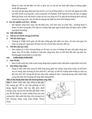 đồng tín hiệu với đĩa đệm và nhô ra phía sau so với bờ sau thân đốt sống và không ngấm
thuốc đối quang từ.
 Các ảnh cắt dọc giúp đánh giá toàn bộ CS, vị trí và số tầng thoát vị. Các ảnh cắt ngang cho thấy
các kiểu thoát vị (trung tâm, cạnh trung tâm và lỗ ghép). Phối hợp hình ảnh cắt dọc và ngăng
đánh giá được mức độ thoát vị chèn ép vào tuỷ sống và rễ TK, gây đè ép khoang dịch não tủy
và phù tủy cùng mức. Các chi tiết về xương trên MRI cho hình ảnh không rõ lắm.
4. Các xét nghiệm sinh hóa – tế bào:
 Xét nghiệm công thức máu, tốc độ lắng máu, sinh hóa máu và nước tiểu… thường được ít
được chỉ định trong đau TKT cấp trừ trường hợp nghi ngờ có phối hợp với bệnh viêm nhiễm
hay bệnh hệ thống.
VII. THỂ LÂM SÀNG
1. Thể teo cơ nhanh còn gọi là thể liệt
2. Thể H/c đuôi ngựa
 Thường là TVĐĐ chính giữa vỡ hết dây chằng gây liệt mềm hai chân, rối loạn cảm giác hai
chân và vùng yên ngựa kèm rối loạn cơ tròn như bí tiểu, táo bón, bất lực.
3. Thể đau dây tọa 2 bên
 Ðau xuống cả 2 chân nhưng không có rối loạn cơ tròn và không rối loạn cảm giác vùng yên
ngựa. Đau rễ hai bên, thường là một bên nặng hơn, đau có thể thay đổi bên này bên kia,
thường gặp trong thoát vị trung tâm.
VIII. CHẨN ĐOÁN PHÂN BIỆT
1. Ðau TK đùi:
 Ðau ở mặt trước đùi, mặt trước-trong cẳng chân và giảm hoặc mất phản xạ gân bánh chè (L4).
2. Ðau khớp cùng chậu:
 Cũng có biểu hiện đau vùng CS thắt lưng-cùng, giữa hai mông, vùng chậu hông, có thể kèm
teo cơ mông. Đau thường có tính chất âm ỉ, kéo dài, có thể lan xuống dưới mông và mặt sau
đùi như đau TKT nhưng khi đè hai mào chậu xuống thì đau. X-quang khung chậu thấy khớp
cùng chậu bên tổn thương mờ hoặc biến dạng (dính).
Một số thủ thuật phát hiện tổn thương khớp cùng chậu
Cách 1: Bệnh nhân nằm sấp, hông và gối gấp,
đùi vuông góc 900
so với mặt giường và hơi
dạng. Người khám một tau đặt phía dưới
xương cùng, tay kia bao lấy đầu gối bệnh nhân
sau đó đè hoặc ấn mạnh xuống theo trục dọc
xương đùi. Nếu xuất hiện đau chói chứng tỏ có
tổn thương khớp cùng chậu. (Thigh Thrust
Test).
 