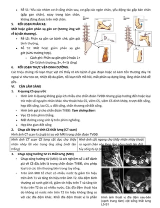  Rễ S1: Yếu các nhóm cơ ở cẳng chân sau, cơ gấp các ngón chân, yếu động tác gấp bàn chân
(gấp gan chân), xoay trong bàn chân,
không đứng được trên mũi chân.
5. RỐI LOẠN PHẢN XẠ:
Mất hoặc giảm phản xạ gân cơ (tương ứng với
rễ bị tổn thương).
 Rễ L5: Phản xạ gân cơ bánh chè, gân gót
bình thường.
 Rễ S1: Mất hoặc giảm phản xạ gân
gót (60% trường hợp).
o Cách ghi: Phản xạ gân gót 0 hoặc 1+
(2+ là bình thường; 3+, 4+ là tăng)
6. RỐI LOẠN THỰC VẬT-DINH DƯỠNG:
Các triệu chứng rối loạn thực vật chỉ thấy rõ khi bệnh ở giai đoạn hoặc có kèm tổn thương dây TK
ngoại vi như teo cơ, nhiệt độ da giảm, rối loạn tiết mồ hôi, mất phản xạ dựng lông, lông chân khô dễ
gãy.
VI. CẬN LÂM SÀNG
1. X-quang CS quy ước
 Hình ảnh X-Quang không giúp ích nhiều cho chẩn đoán TVĐĐ nhưng giúp hướng đến hoặc loại
trừ một số nguyên nhân khác như thoát hóa CS, viêm CS, viêm CS dính khớp, trượt đốt sống,
hẹp đốt sống, lao CS, u đốt sống, chấn thương vỡ đốt sống.
 Hình ảnh gợi ý cho chẩn đoán TVĐĐ: Tam chứng Barr:
 Vẹo CS trên phim thẳng.
 Mất đường cong sinh lý trên phim nghiêng.
 Hẹp khe gian đốt sống
2. Chụp cắt lớp vi tính CS thắt lưng (CT scan)
Hình ảnh CT scan ít có giá trị so với MRI trong chẩn đoán TVĐĐ
Hình ảnh CT scan CS lưng cắt dọc cho thấy
nhân nhày lồi vào trong ống sống (mũi tên
trắng)
Hình ảnh cắt ngang cho thấy nhân nhày thoát
ra ngoài chèn vào lòng ống sống (mũi tên đỏ),
tủy sống bị ép (mũi tên xanh)
3. Chụp cộng hưởng từ CS thắt lưng (MRI)
 Chụp cộng hưởng từ (MRI): là xét nghiệm số 1 để đánh
giá về CS đặc biệt là trong chẩn đoán TVĐĐ, cho phép
loại trừ các tổn thương bên trong tủy sống.
 Trên ảnh MRI tổ chức có nhiều nước bị giảm tín hiệu
trên ảnh T1 và tăng tín hiệu trên ảnh T2. Đĩa đệm bình
thường có ranh giới rõ, giảm tín hiệu trên T và tăng tín
hi ệu trên T2 do có nhiều nước. Các đĩa đệm thoái hóa
do không có nước nên trên T2 tín hiệu không tăng so
với các đĩa đệm khác. Khối đĩa đệm thoát vị là phần
 