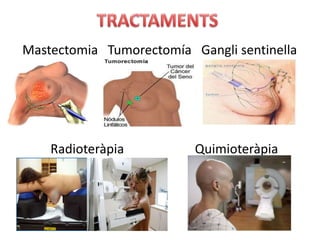 Mastectomia Tumorectomía Gangli sentinella




    Radioteràpia          Quimioteràpia
 