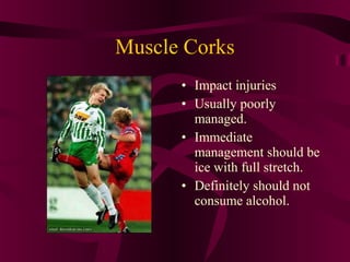 Muscle Corks
• Impact injuries
• Usually poorly
managed.
• Immediate
management should be
ice with full stretch.
• Definitely should not
consume alcohol.
 