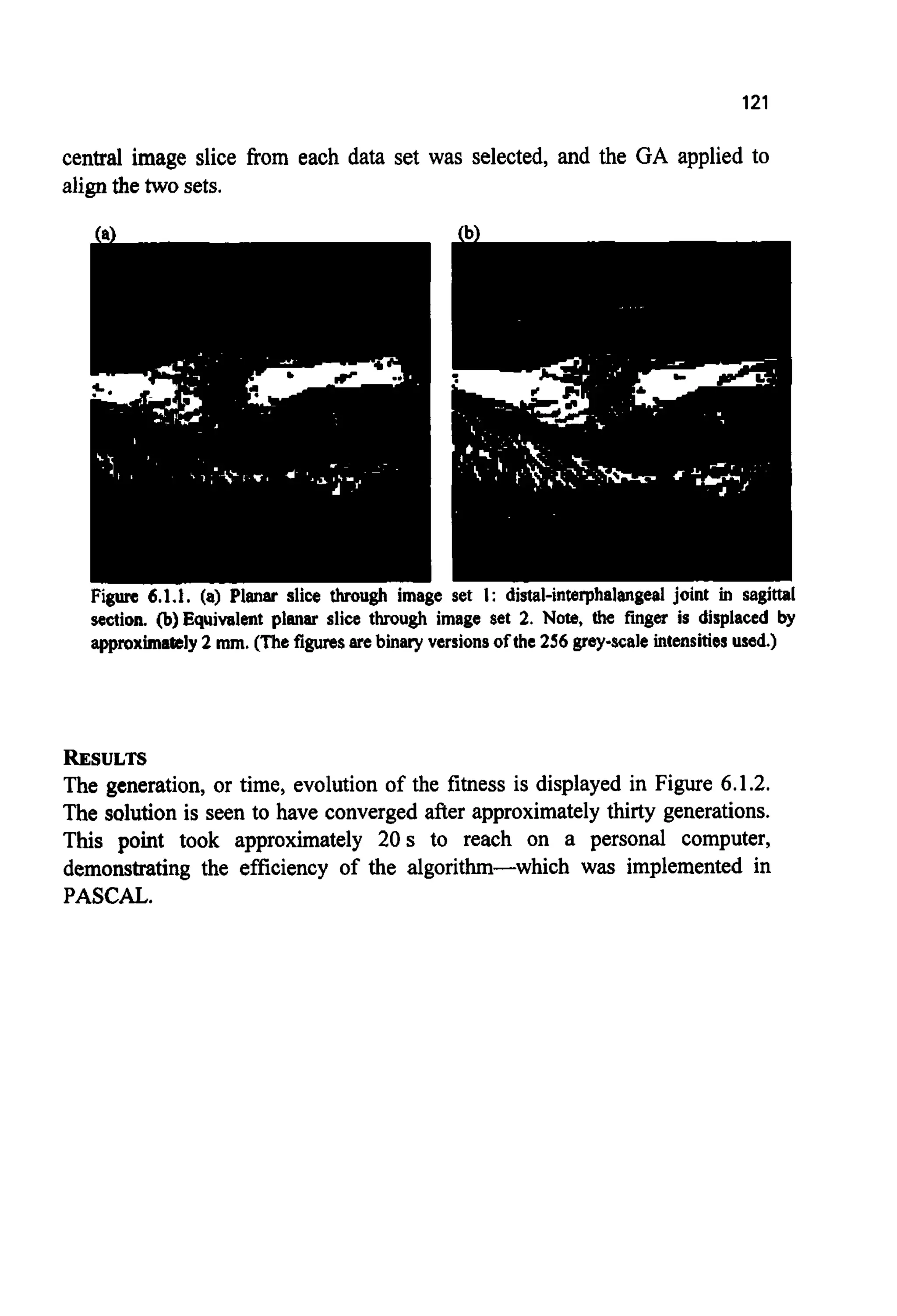 121
central image slice from each data set was selected, and the GA applied to
align the two sets.
Figure 6.1.1. (a) Planar slice through image set 1: distal-interphalangeal joint in sagittal
section. @)Equivalent planar slice through image set 2. Note, the finger is displaced by
approximately2 mm. (The figuresarebinary versionsof the 256 grey-scaleintensitiesused.)
RESULTS
The generation, or time, evolution of the fitness is displayed in Figure 6.1.2.
The solution is seen to have converged after approximately thirty generations.
This point took approximately 20 s to reach on a personal computer,
demonstrating the efflciency of the algorithm-which was implemented in
PASCAL.
 