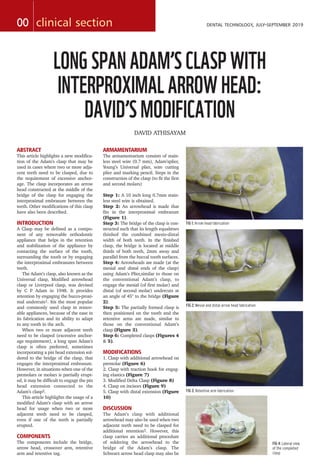 ABSTRACT
This article highlights a new modifica-
tion of the Adam’s clasp that may be
used in cases where two or more adja-
cent teeth need to be clasped, due to
the requirement of excessive anchor-
age. The clasp incorporates an arrow
head constructed at the middle of the
bridge of the clasp for engaging the
interproximal embrasure between the
teeth. Other modifications of this clasp
have also been described.
INTRODUCTION
A Clasp may be defined as a compo-
nent of any removable orthodontic
appliance that helps in the retention
and stabilization of the appliance by
contacting the surface of the tooth,
surrounding the tooth or by engaging
the interproximal embrasures between
teeth.
The Adam’s clasp, also known as the
Universal clasp, Modified arrowhead
clasp or Liverpool clasp, was devised
by C P Adam in 1948. It provides
retention by engaging the bucco-proxi-
mal undercuts1. Itis the most popular
and commonly used clasp in remov-
able appliances, because of the ease in
its fabrication and its ability to adapt
to any tooth in the arch.
When two or more adjacent teeth
need to be clasped (excessive anchor-
age requirement), a long span Adam’s
clasp is often preferred, sometimes
incorporating a pin head extension sol-
dered to the bridge of the clasp, that
engages the interproximal embrasure.
However, in situations when one of the
premolars or molars is partially erupt-
ed, it may be difficult to engage the pin
head extension connected to the
Adam’s clasp2.
This article highlights the usage of a
modified Adam’s clasp with an arrow
head for usage when two or more
adjacent teeth need to be clasped,
even if one of the teeth is partially
erupted.
COMPONENTS
The components include the bridge,
arrow head, crossover arm, retentive
arm and retentive tag.
ARMAMENTARIUM
The armamentarium consists of stain-
less steel wire (0.7 mm), Adam’splier,
Young’s Universal plier, wire cutting
plier and marking pencil. Steps in the
construction of the clasp (to fit the first
and second molars)
Step 1: A 10 inch long 0.7mm stain-
less steel wire is obtained.
Step 2: An arrowhead is made that
fits in the interproximal embrasure
(Figure 1).
Step 3: The bridge of the clasp is con-
structed such that its length equalstwo
thirdsof the combined mesio-distal
width of both teeth. In the finished
clasp, the bridge is located at middle
thirds of both teeth, 2mm away and
parallel from the buccal tooth surfaces.
Step 4: Arrowheads are made (at the
mesial and distal ends of the clasp)
using Adam’s Plier,similar to those on
the conventional Adam’s clasp, to
engage the mesial (of first molar) and
distal (of second molar) undercuts at
an angle of 45° to the bridge (Figure
2).
Step 5: The partially formed clasp is
then positioned on the tooth and the
retentive arms are made, similar to
those on the conventional Adam’s
clasp (Figure 3).
Step 6: Completed clasps (Figures 4
& 5).
MODIFICATIONS
1. Clasp with additional arrowhead on
premolar (Figure 6)
2. Clasp with traction hook for engag-
ing elastics (Figure 7)
3. Modified Delta Clasp (Figure 8)
4. Clasp on incisors (Figure 9)
5. Clasp with distal extension (Figure
10)
DISCUSSION
The Adam’s clasp with additional
arrowhead may also be used when two
adjacent teeth need to be clasped for
additional retention3. However, this
clasp carries an additional procedure
of soldering the arrowhead to the
bridge of the Adam’s clasp. The
Schwarz arrow head clasp may also be
00 clinical section DENTAL TECHNOLOGY, JULY-SEPTEMBER 2019
LONG SPAN ADAM’S CLASP WITH
INTERPROXIMAL ARROW HEAD:
DAVID’S MODIFICATION
DAVID ATHISAYAM
FIG 1: Arrow head fabrication
FIG 2: Mesial and distal arrow head fabrication
FIG 3: Retentive arm fabrication
FIG 4: Lateral view
of the completed
clasp
 