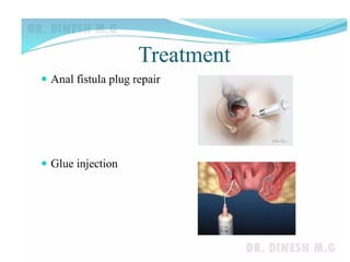 Comprehensive Overview of Anal Fissure, Fistula in Ano, and Anorectal ...