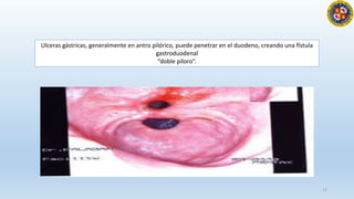 17
Ulceras gástricas, generalmente en antro pilórico, puede penetrar en el duodeno, creando una fístula
gastroduodenal
“doble píloro”.
 