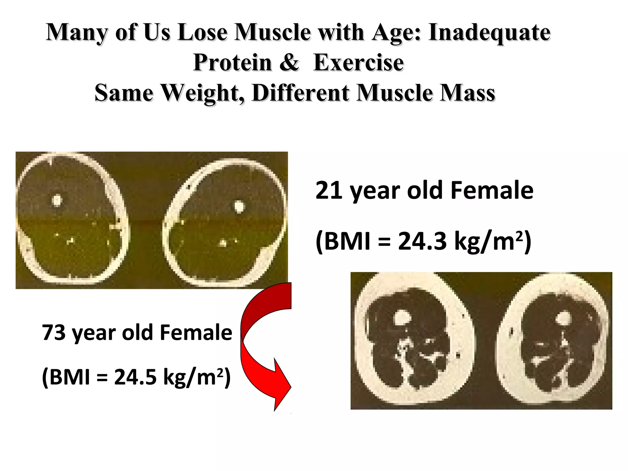 Many of Us Lose Muscle with Age: InadequateMany of Us Lose Muscle with Age: Inadequate
Protein & ExerciseProtein & Exercise
Same Weight, Different Muscle MassSame Weight, Different Muscle Mass
21 year old Female
(BMI = 24.3 kg/m2
)
73 year old Female
(BMI = 24.5 kg/m2
)
 
