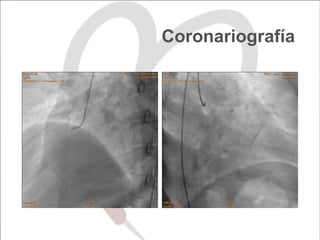 Coronariografía
 