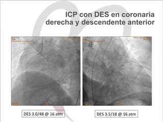 ICP con DES en coronaria
derecha y descendente anterior
DES	3.0/48	@	16	atm	 DES	3.5/18	@	16	atm	
 