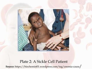 Plate 2: A Sickle Cell Patient
Source: https://biochemist01.wordpress.com/tag/anemia-cause/
 