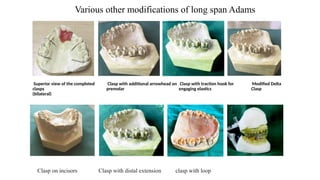 Comprehensive Guide to Long Span Adam’s Clasp with Interproximal Arrow ...