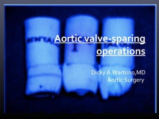 Aortic valve-sparing
operations
Dicky A.Wartono,MD
Aortic Surgery
 