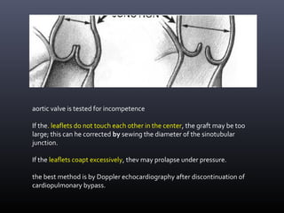 aortic valve is tested for incompetence
If the. leaflets do not touch each other in the center, the graft may be too
large; this can he corrected by sewing the diameter of the sinotubular
junction.
If the leaflets coapt excessively, thev may prolapse under pressure.
the best method is by Doppler echocardiography after discontinuation of
cardiopulmonary bypass.
 