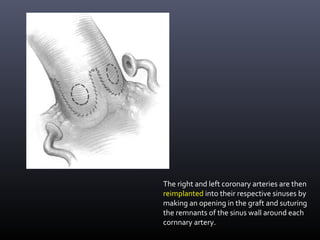 The right and left coronary arteries are then
reimplanted into their respective sinuses by
making an opening in the graft and suturing
the remnants of the sinus wall around each
cornnary artery.
 