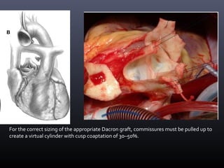 For the correct sizing of the appropriate Dacron graft, commissures must be pulled up to
create a virtual cylinder with cusp coaptation of 30–50%.
 