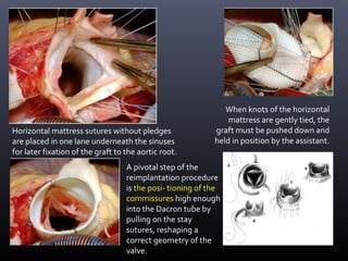 Horizontal mattress sutures without pledges
are placed in one lane underneath the sinuses
for later fixation of the graft to the aortic root.
When knots of the horizontal
mattress are gently tied, the
graft must be pushed down and
held in position by the assistant.
A pivotal step of the
reimplantation procedure
is the posi- tioning of the
commissures high enough
into the Dacron tube by
pulling on the stay
sutures, reshaping a
correct geometry of the
valve.
 
