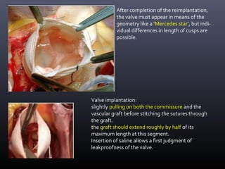 Valve implantation:
slightly pulling on both the commissure and the
vascular graft before stitching the sutures through
the graft.
the graft should extend roughly by half of its
maximum length at this segment.
Insertion of saline allows a first judgment of
leakproofness of the valve.
After completion of the reimplantation,
the valve must appear in means of the
geometry like a ‘Mercedes star’, but indi-
vidual differences in length of cusps are
possible.
 