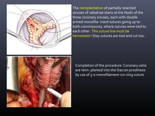 Completion of the procedure: Coronary ostia
are reim- planted into the Dacron prosthesis
by use of 5-0 monofilament run ning suture
The reimplantation of partially resected
sinuses of valsalvae starts at the Nadir of the
three coronary sinuses, each with double
armed monofila- ment sutures going up to
both commissures, where sutures were tied to
each other. This suture line must be
hemostatic! Stay sutures are tied and cut too.
 