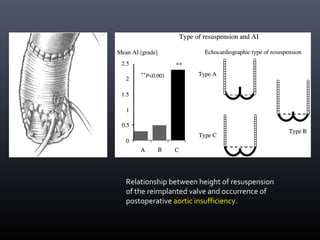 Relationship between height of resuspension
of the reimplanted valve and occurrence of
postoperative aortic insufficiency.
 