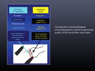 Intraoperative transesophageal
echocardiographic criteria to appreciate
quality of the result after valve repair
 