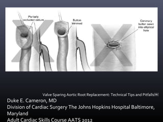 Valve Sparing Aortic Root Replacement: Technical Tips and Pitfalls￼
Duke E. Cameron, MD
Division of Cardiac Surgery The Johns Hopkins Hospital Baltimore,
Maryland
Adult Cardiac Skills Course AATS 2012
 