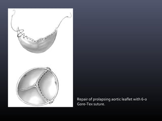 Repair of prolapsing aortic leaflet with 6-0
Gore-Tex suture.
 