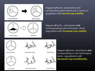 Diagram of aortic valve lesions and
corresponding re- pair teechniques.
Aortic. regurgitation with
decreased cusp moobilitydity.
Iliagram of aortic. valve lesions and
correcspondingrt.pair techniques. Aortic
reguritation with increased cusp mobility
Diagram of aortic. valve lesions and
rorrrsponding repair technic1ue.s. Aortic re-
gurgitation with normal cusp mobility.
 