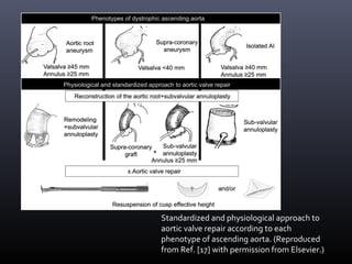 Standardized and physiological approach to
aortic valve repair according to each
phenotype of ascending aorta. (Reproduced
from Ref. [17] with permission from Elsevier.)
 