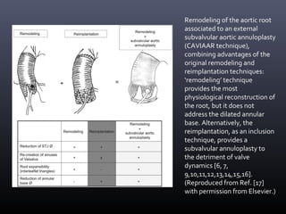 Remodeling of the aortic root
associated to an external
subvalvular aortic annuloplasty
(CAVIAAR technique),
combining advantages of the
original remodeling and
reimplantation techniques:
‘remodeling’ technique
provides the most
physiological reconstruction of
the root, but it does not
address the dilated annular
base. Alternatively, the
reimplantation, as an inclusion
technique, provides a
subvalvular annuloplasty to
the detriment of valve
dynamics [6, 7,
9,10,11,12,13,14,15,16].
(Reproduced from Ref. [17]
with permission from Elsevier.)
 