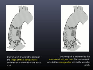 Dacron graft is anchored to the
aortoventricular junction. The native aortic
valve is then resuspended within the vascular
graft.
Dacron graft is tailored to conform
the shape of the 3 aortic sinuses
and then anastomosed to the aortic
root.
 